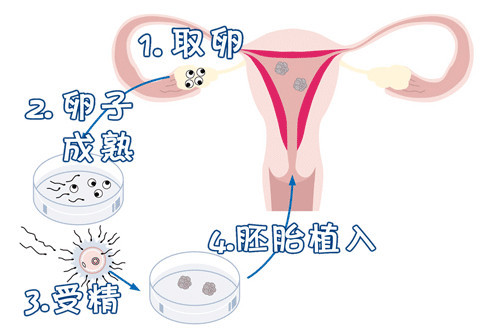 试管助孕生男孩生殖中心